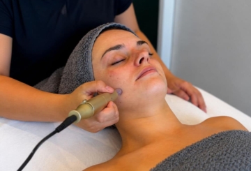 Microneedling